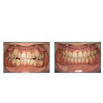 歯列矯正の方法について